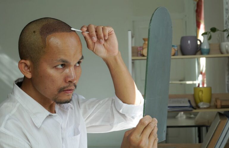 حكة الرأس بعد زراعة الشعر