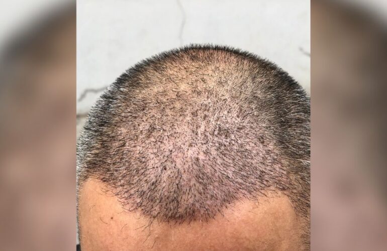 كم عدد جلسات زراعة الشعر