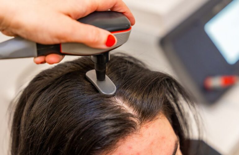 علاج تساقط الشعر بالليزر