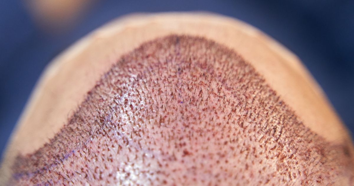 نصائح لضمان نجاح عملية زراعة الشعر