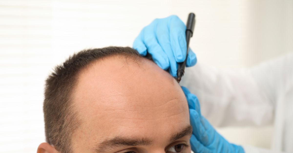 تقنيات زراعة الشعر