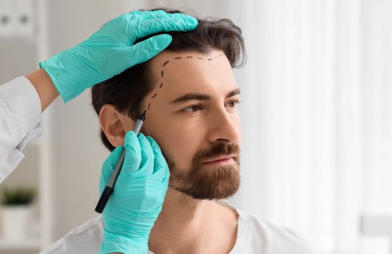 متى تثبت البصيلات بعد زراعة الشعر