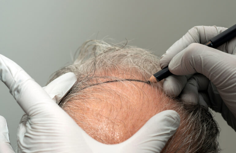 زراعة الشعر الطبيعي