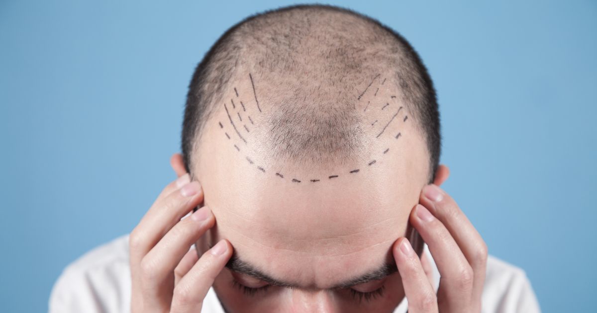 نتائج زراعة الشعر بعد 3 شهور