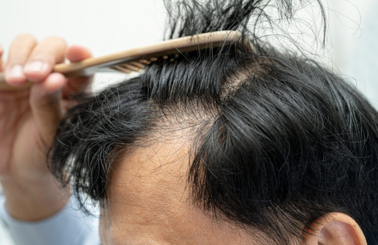 أهم نصائح العناية بالشعر بعد عملية زراعة الشعر