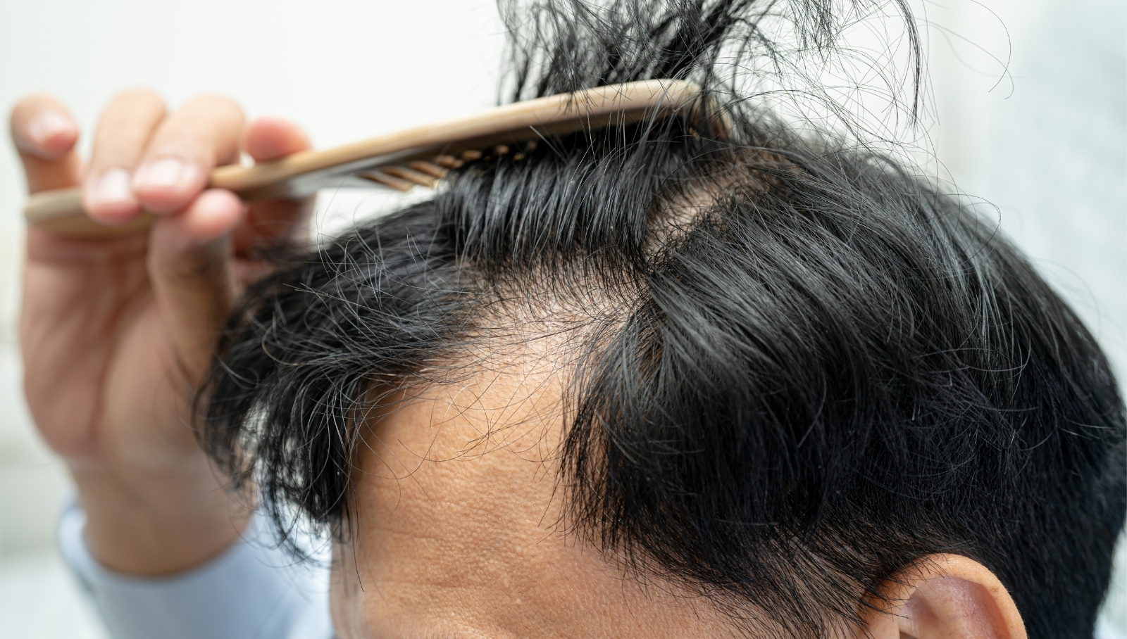 أهم نصائح العناية بالشعر بعد عملية زراعة الشعر