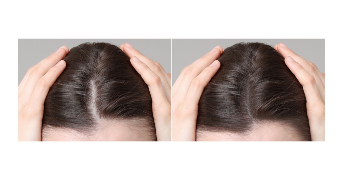 تجربتي مع زراعة الشعر في مصر