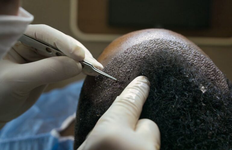اسئلة شائعة عن عملية زراعة الشعر في مصر