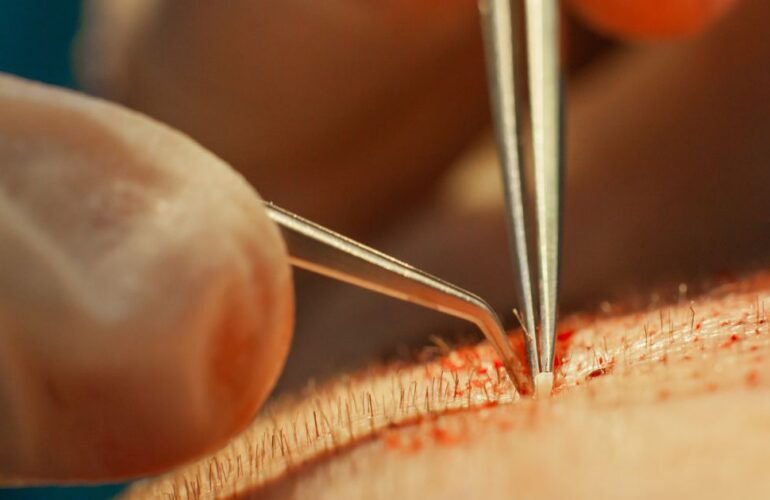 اسئلة شائعة عن عملية زراعة الشعر