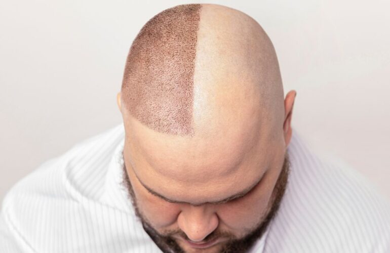 عوامل مؤثرة على تكلفة زراعة الشعر