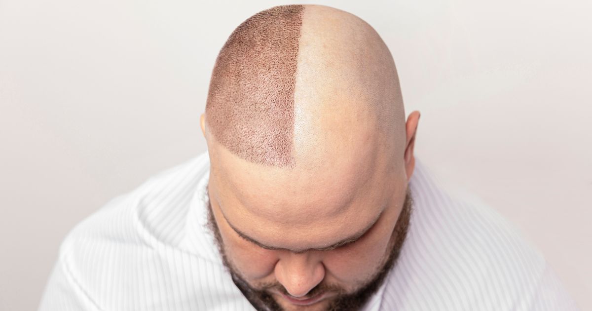 عوامل مؤثرة على تكلفة زراعة الشعر