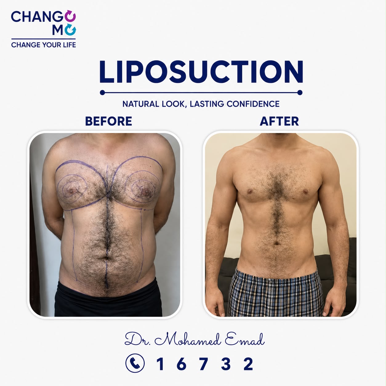 lipo-before-after-0