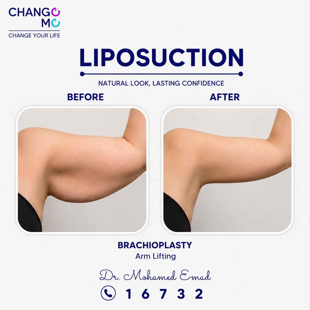 lipo-before-after-02