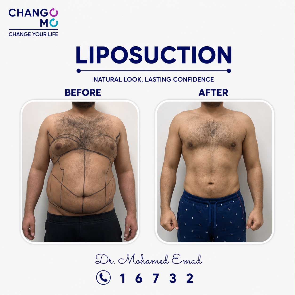 lipo-before-after-03