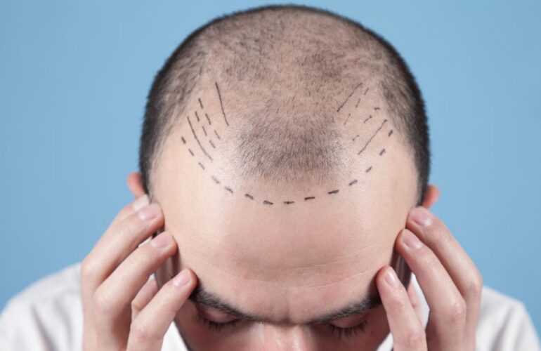 مراكز زراعة الشعر فى مصر