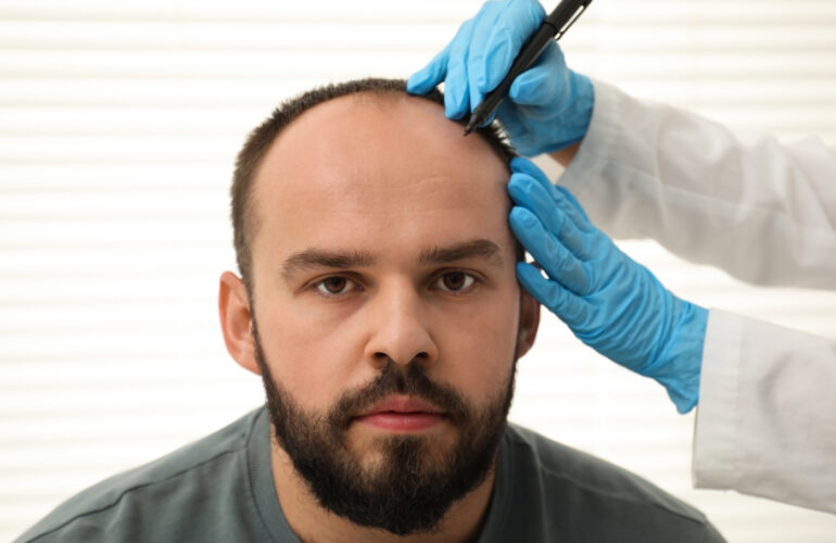 زراعة الشعر بدون حلاقة