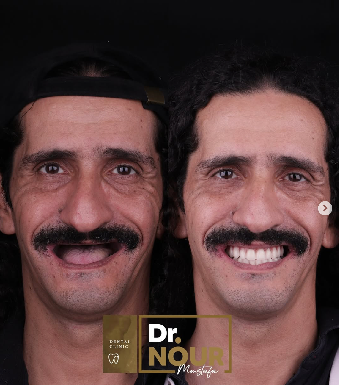 زراعة-الاسنان